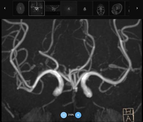 รายการ 93 ภาพ ภาพ Mri สมอง อัปเดต