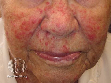 rosacea dermnet nz acne red face nc commons