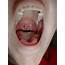 Uvula Infection  FUNGAL INFECTION ON SKIN