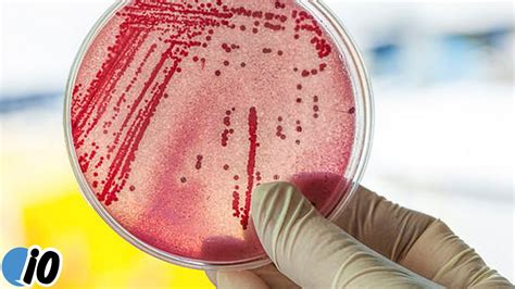 Deadly Bacteria Infection Spreading In The Us Youtube