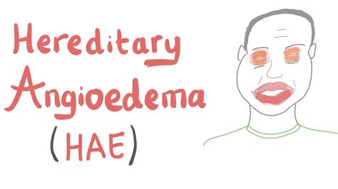 Hereditary Angioedema Hereditary And Acquired Angioedema Immunology