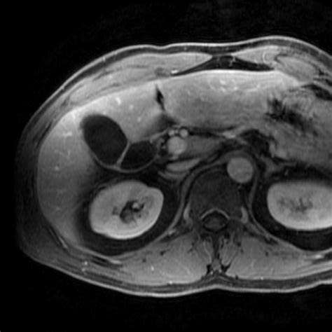 Segmentation Of The Gallbladder Image