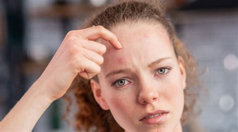 Hives On The Forehead Everything You Need To Know