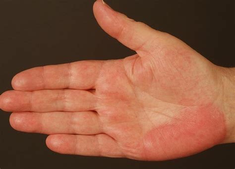 Red Spots On Palm Of Hand Pictures Photos Images And Photos Finder