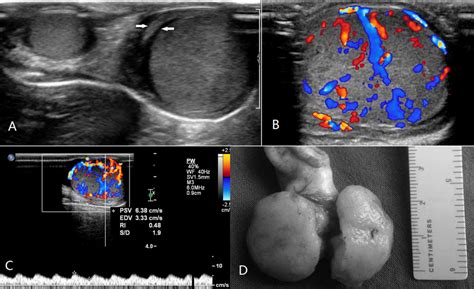 Ultrasound Appearances Of Pediatric Testicular Yolk Sac Tumors Twenty