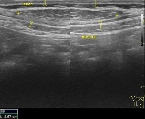 Anterior abdominal wall lipoma | Image | Radiopaedia.org
