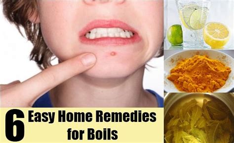 6 Easy Home Remedies For Boils Home Remedy For Boils Skin Natural
