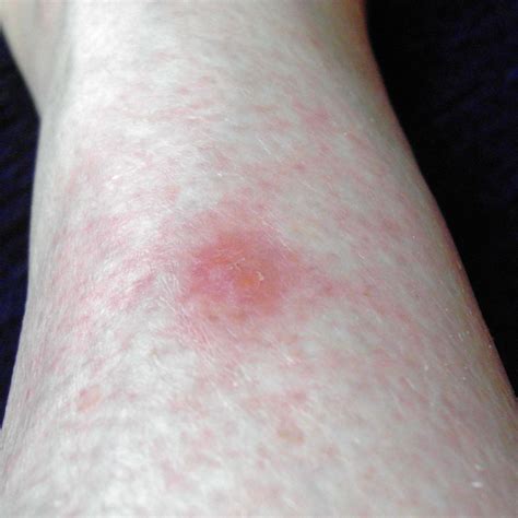 Brown Recluse Spider Bite First Hour Images And Photos Finder