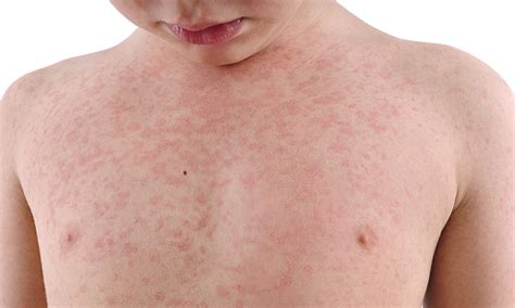 Measles Cases In England Almost Quadrupled In 2018 Which