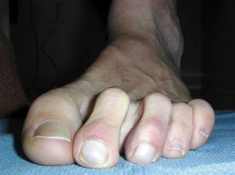 Why Is There A Pin Put In The Toe After Hammer Toe Surgery