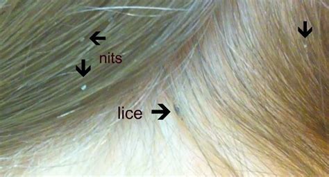 Lice Lice Infestation And Treatment Lice Louse Singular Are Parasitic