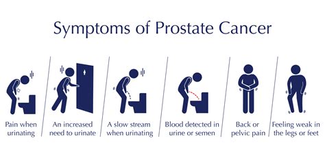 Warning Signs Of Prostate Cancer Journotalk