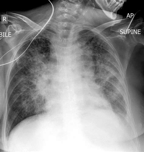 Chest X Ray Lobar Pneumonia