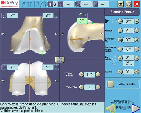 Comment se déroule l'opération ? Chirurgie assistée par ordinateur et Prothèse totale de ...
