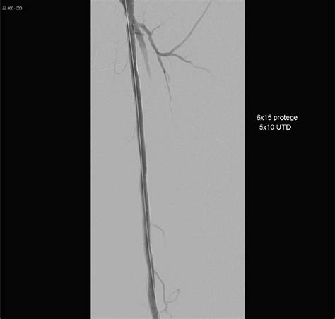 Endovascular Today Sex Related Differences In Lower Extremity Peripheral Artery Disease
