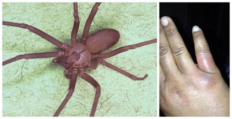 What You Need To Know About Brown Recluse Spider Bites