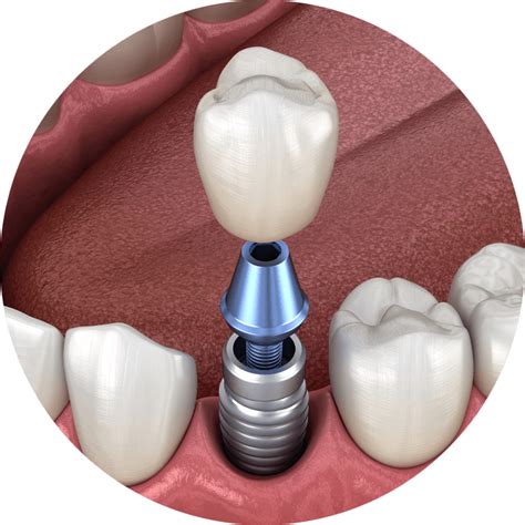 Missing or Failing Teeth | Daren Dental Family Dentistry | East Lyme, CT