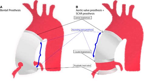 Schematic View Of The Bentall Prosthesis A And Scar Prosthesis