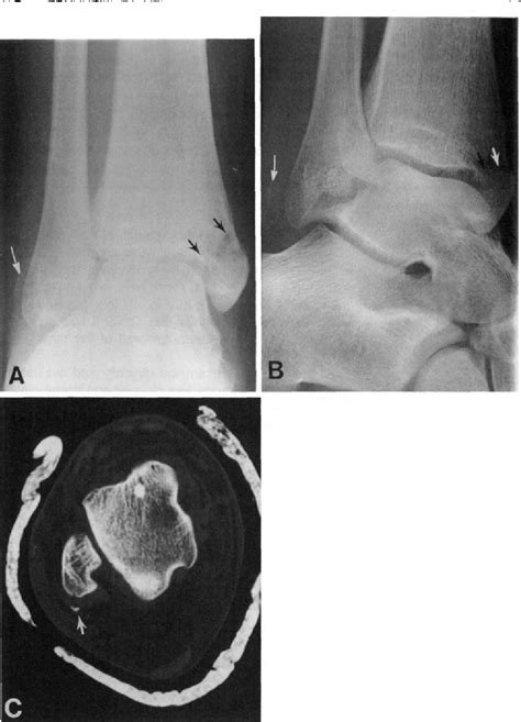 Figure 1 From Marginal Fractures Of The Lateral Malleolus In