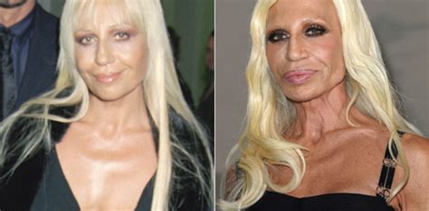 Donatella Versace Plastic Surgery Gone Wrong Before And After Photos My XXX Hot Girl
