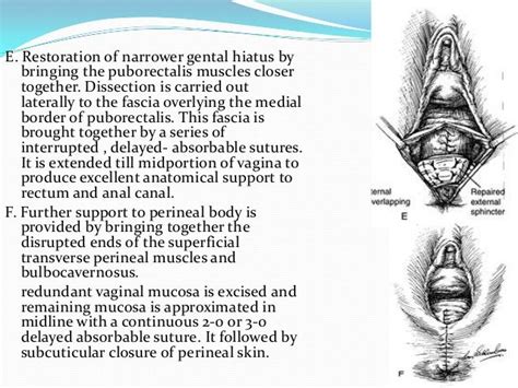 Perineal Lacerations In 2021 Absorbable Suture Perineal Tear Perineum