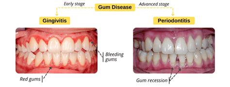 Gingivitis Vs Periodontitis Share Dental Care