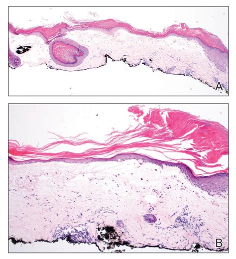 Hyperkeratotic Nummular Plaques On The Upper Trunk Mdedge Dermatology