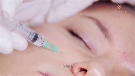 Acne Scar Treatments Using Dermal Fillers An Educational Video By