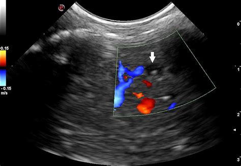 Color Doppler Examination Of The Liver Showing An Intraparenchymal Cyst