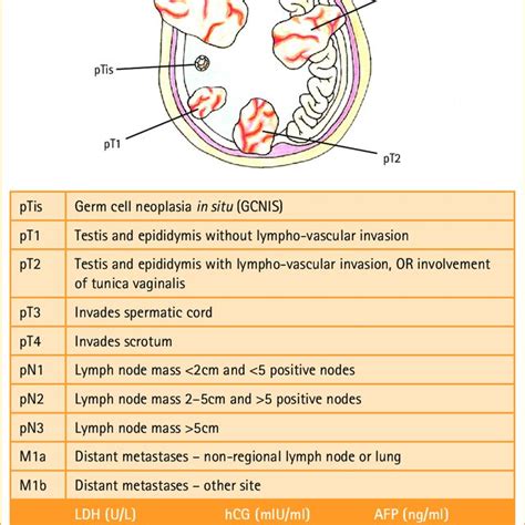 Diagram And Summary Of Tnm Staging For Testicular Cancer Drawing By