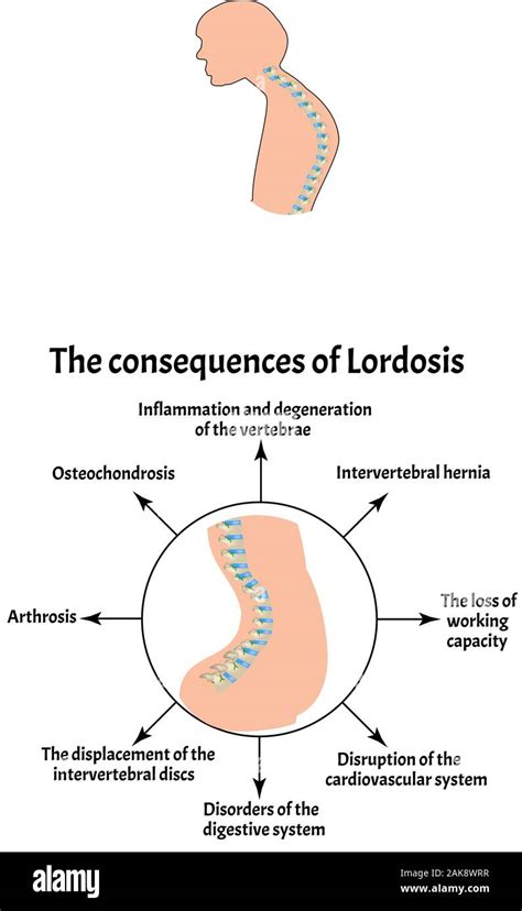 The Consequences Of Lordosis Spinal Curvature Kyphosis Lordosis