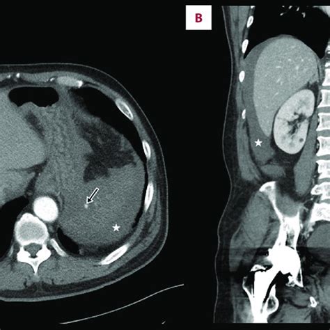 Contrast Enhanced Computed Tomography Ct Scan Of The Abdomen