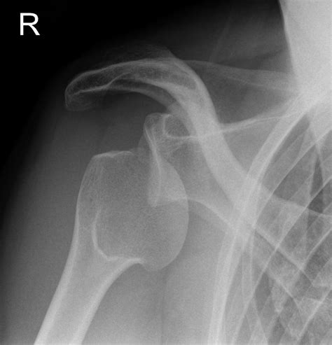 Shoulder Dislocation X Ray Images And Treatments New Health Advisor