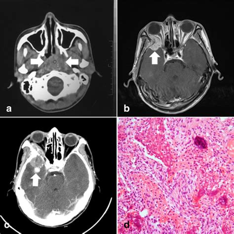 Radiation Induced Sarcoma In A Patient With Nasopharyngeal Carcinoma