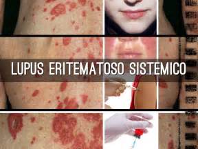 Lupus Eritematoso Sistemico Cause Sintomi Diagnosi Cura E Prevenzione