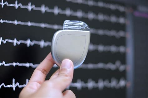 What You Need To Know About The Implantable Cardioverter Defibrillator