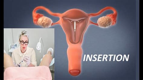 Iud Insertion Copper And Hormonal Iuds Prevent Pregnancy Intrauterine Devices Placement Youtube