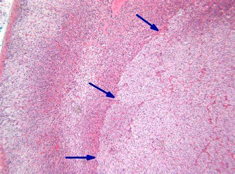 Пигментация при гиперплазии надпочечника - фото презентация Картинка - Пигментация при гиперплазии надпочечника - фото презентация