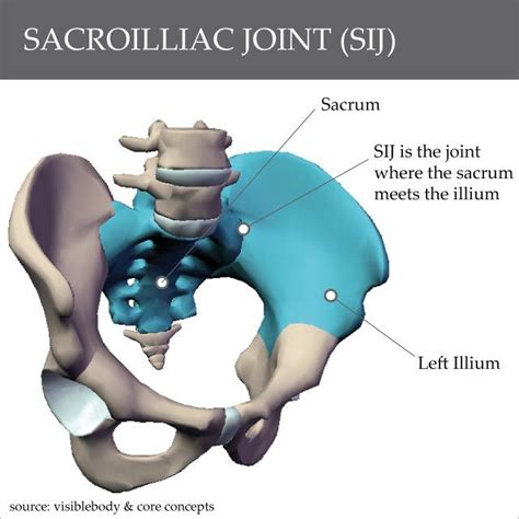 The Unstable Sacro Iliac Joint SIJ
