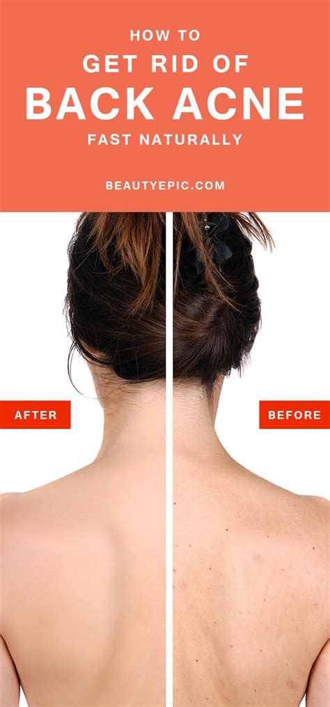 How To Get Rid Of Back Acne Fast Naturally Back Acne Treatment