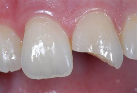 Tooth Fracture Enamel Tooth Fracture Enamel Kazemi Oral Surgery