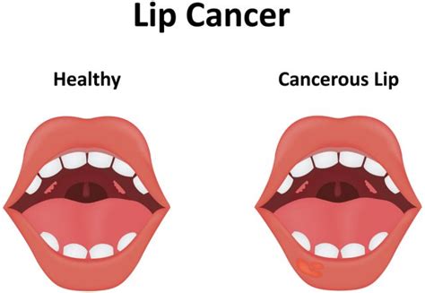 Learn Bump On Inside Of Lip Causes And Treatment Of White Spots Porn