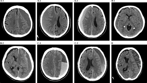Identification Of Chronic Subdural Hematoma Types Most Responsive To