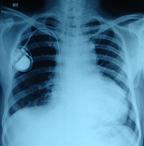 Single Chamber Pacemaker On Chest X Ray Pa All About Cardiovascular