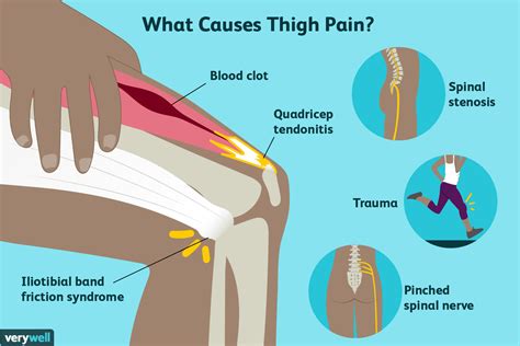 Where are the hip flexors located? Douleurs de la cuisse : causes, traitement et quand ...