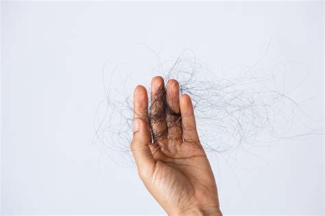 Discover More Than 137 Hair Loss Pics Latest Vn