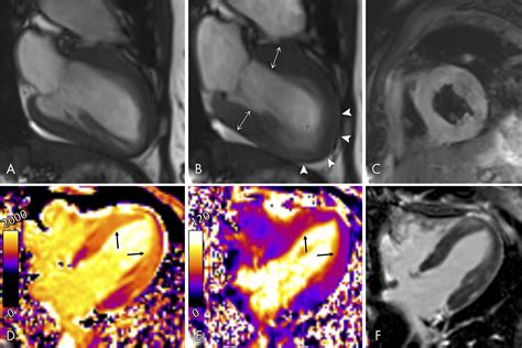 Parametric Imaging For Detection Of Edema In Takotsubo Cardiomyopathy Radiology