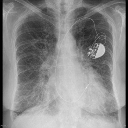 Pulmonary edema is a broad descriptive term and is usually defined as an abnormal accumulation of fluid in the extravascular compartments of the lung 1. Acute pulmonary oedema | Image | Radiopaedia.org