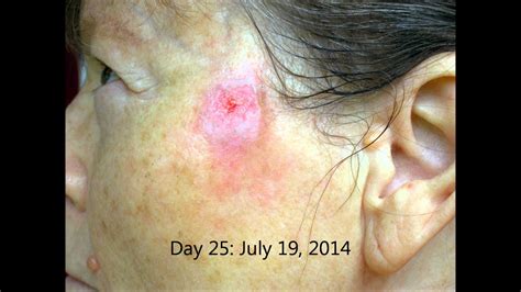 Curaderm On Facial Squamous Cell Carcinoma 53 Days Youtube