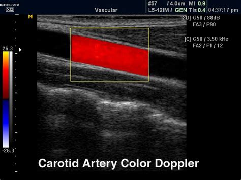 Carotid Doppler Ultrasound
